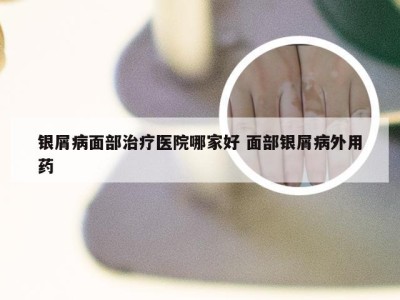 银屑病面部治疗医院哪家好 面部银屑病外用药