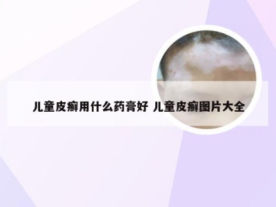 儿童皮癣用什么药膏好 儿童皮癣图片大全