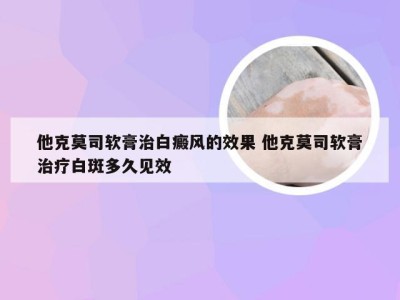 他克莫司软膏治白癜风的效果 他克莫司软膏治疗白斑多久见效