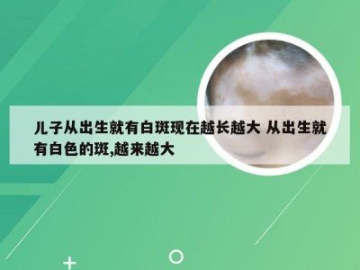 儿子从出生就有白斑现在越长越大 从出生就有白色的斑,越来越大