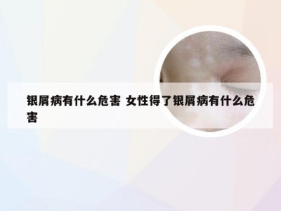 银屑病有什么危害 女性得了银屑病有什么危害