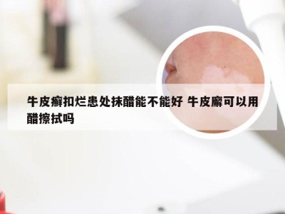 牛皮癣扣烂患处抹醋能不能好 牛皮廨可以用醋擦拭吗