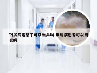 银屑病治愈了可以当兵吗 银屑病患者可以当兵吗