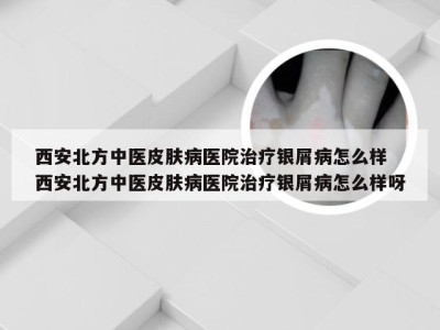 西安北方中医皮肤病医院治疗银屑病怎么样 西安北方中医皮肤病医院治疗银屑病怎么样呀