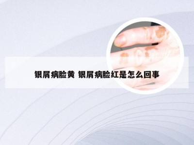 银屑病脸黄 银屑病脸红是怎么回事