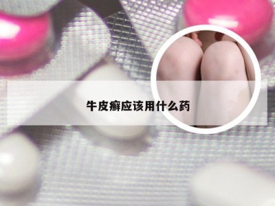 牛皮癣应该用什么药