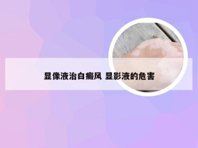 显像液治白癜风 显影液的危害