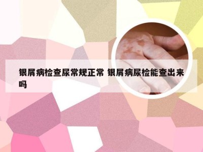 银屑病检查尿常规正常 银屑病尿检能查出来吗