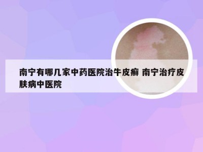 南宁有哪几家中药医院治牛皮癣 南宁治疗皮肤病中医院