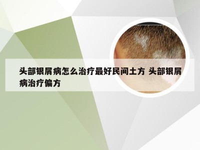 头部银屑病怎么治疗最好民间土方 头部银屑病治疗偏方