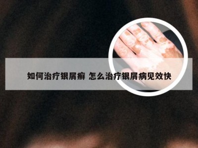 如何治疗银屑癣 怎么治疗银屑病见效快