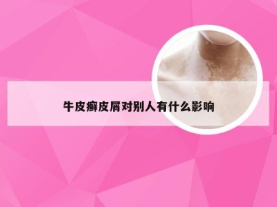 牛皮癣皮屑对别人有什么影响