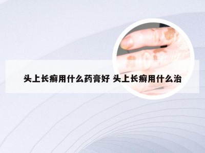 头上长癣用什么药膏好 头上长癣用什么治