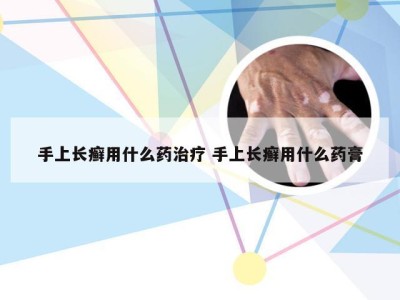 手上长癣用什么药治疗 手上长癣用什么药膏