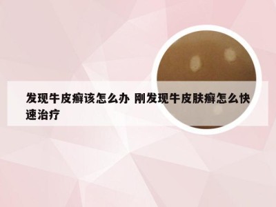 发现牛皮癣该怎么办 刚发现牛皮肤癣怎么快速治疗