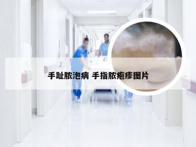 手趾脓泡病 手指脓疱疹图片