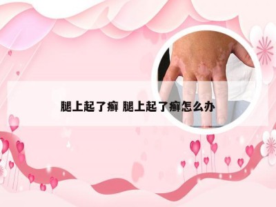 腿上起了癣 腿上起了癣怎么办