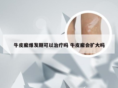 牛皮廨爆发期可以治疗吗 牛皮廨会扩大吗