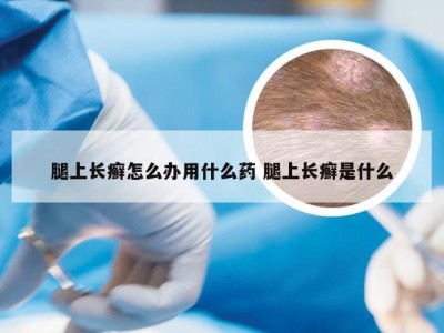 腿上长癣怎么办用什么药 腿上长癣是什么