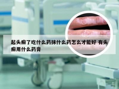 起头癣了吃什么药抹什么药怎么才能好 有头癣用什么药膏