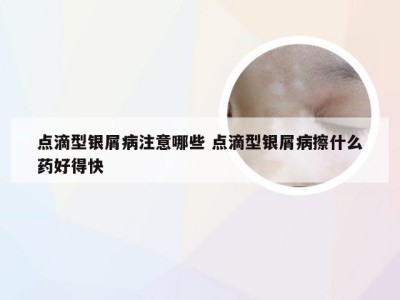 点滴型银屑病注意哪些 点滴型银屑病擦什么药好得快