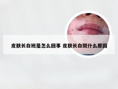 皮肤长白班是怎么回事 皮肤长白斑什么原因