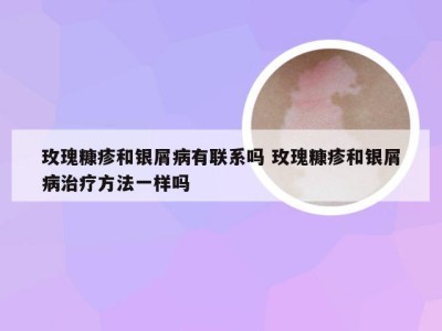 玫瑰糠疹和银屑病有联系吗 玫瑰糠疹和银屑病治疗方法一样吗