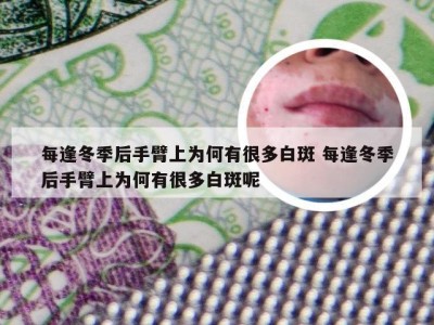 每逢冬季后手臂上为何有很多白斑 每逢冬季后手臂上为何有很多白斑呢