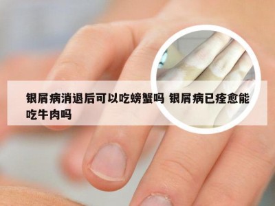 银屑病消退后可以吃螃蟹吗 银屑病已痊愈能吃牛肉吗