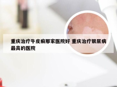 重庆治疗牛皮癣那家医院好 重庆治疗银屑病最高的医院