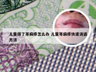 儿童得了荨麻疹怎么办 儿童荨麻疹快速消退方法