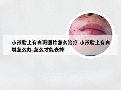 小孩脸上有白斑图片怎么治疗 小孩脸上有白斑怎么办,怎么才能去掉