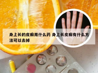 身上长的皮癣用什么药 身上长皮癣有什么方法可以去掉