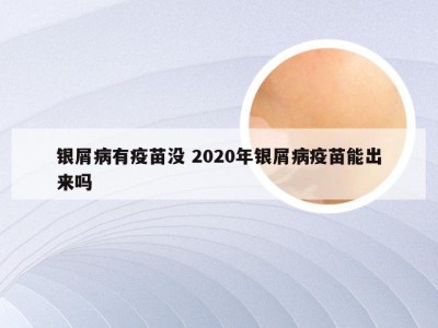 银屑病有疫苗没 2020年银屑病疫苗能出来吗