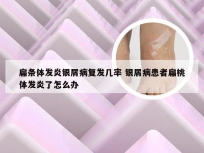 扁条体发炎银屑病复发几率 银屑病患者扁桃体发炎了怎么办