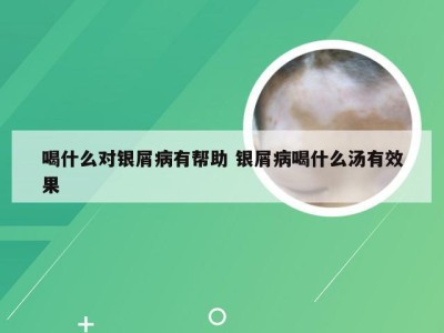 喝什么对银屑病有帮助 银屑病喝什么汤有效果