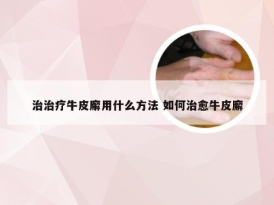 治治疗牛皮廨用什么方法 如何治愈牛皮廨