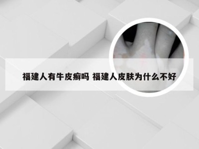 福建人有牛皮癣吗 福建人皮肤为什么不好