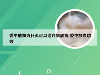 委中放血为什么可以治疗银屑病 委中放血功效