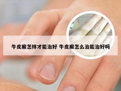 牛皮廨怎样才能治好 牛皮廨怎么治能治好吗