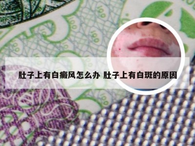 肚子上有白癜风怎么办 肚子上有白斑的原因