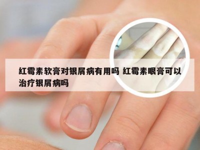 红霉素软膏对银屑病有用吗 红霉素眼膏可以治疗银屑病吗