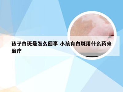 孩子白斑是怎么回事 小孩有白斑用什么药来治疗