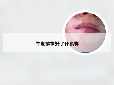 牛皮癣快好了什么样