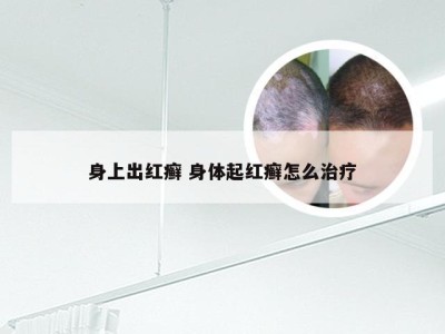 身上出红癣 身体起红癣怎么治疗