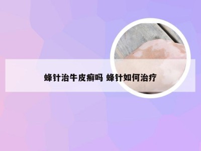 蜂针治牛皮癣吗 蜂针如何治疗