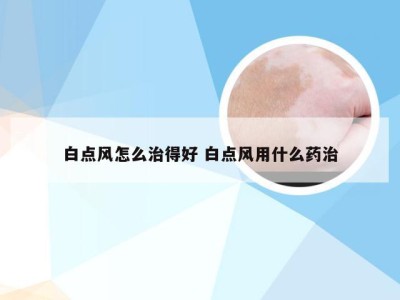 白点风怎么治得好 白点风用什么药治