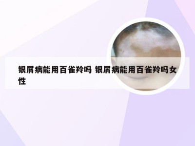 银屑病能用百雀羚吗 银屑病能用百雀羚吗女性