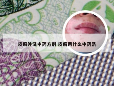 皮癣外洗中药方剂 皮癣用什么中药洗