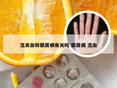 流鼻血和银屑病有关吗 银屑病 流血